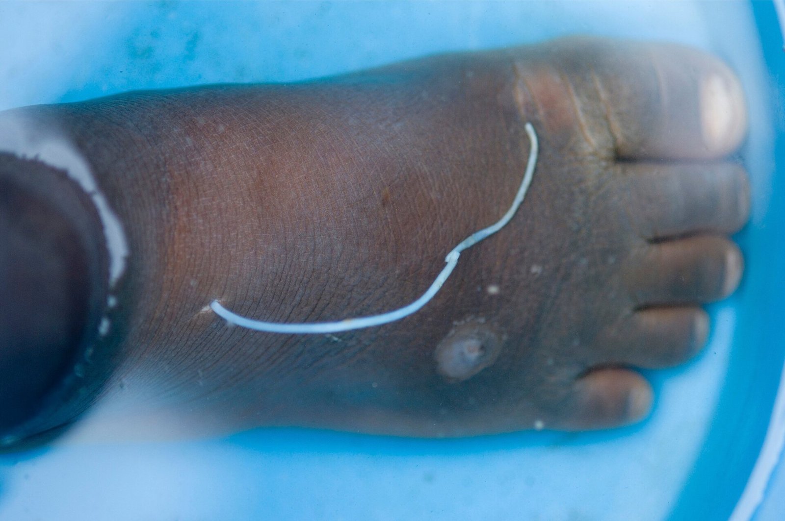 Guinea Worm