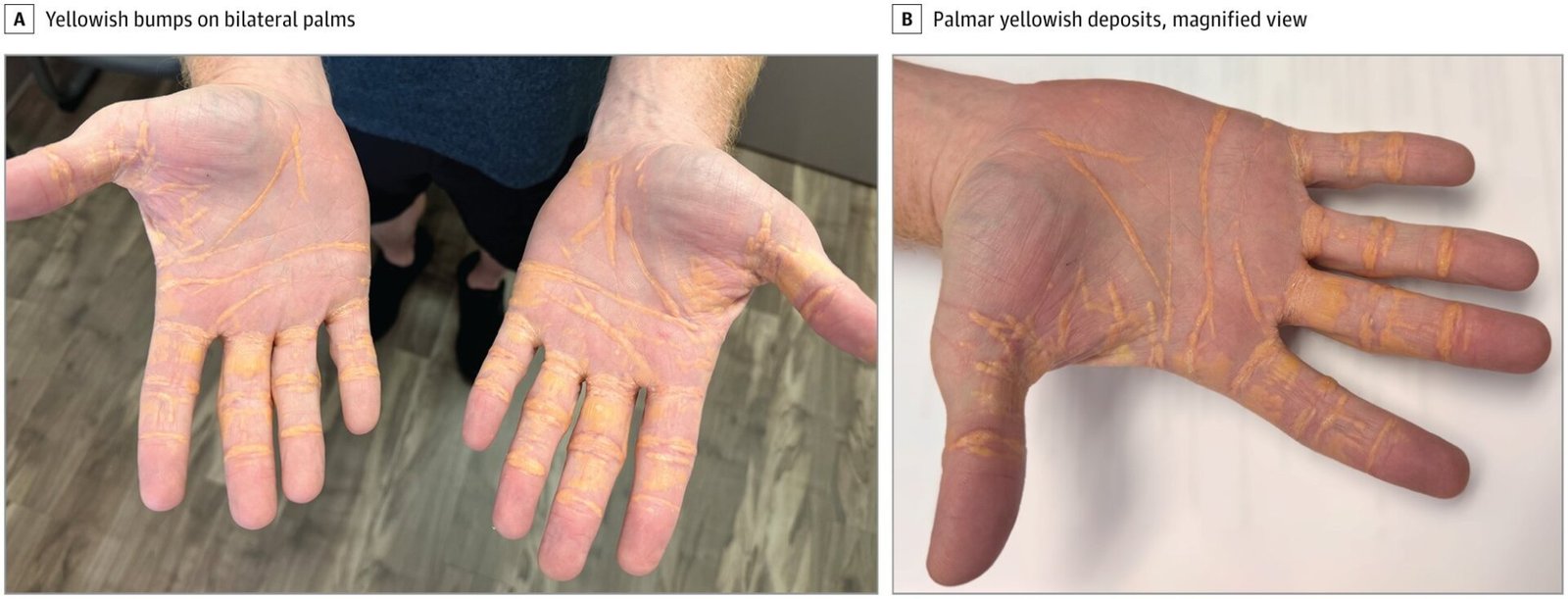 A case of xanthelasma.