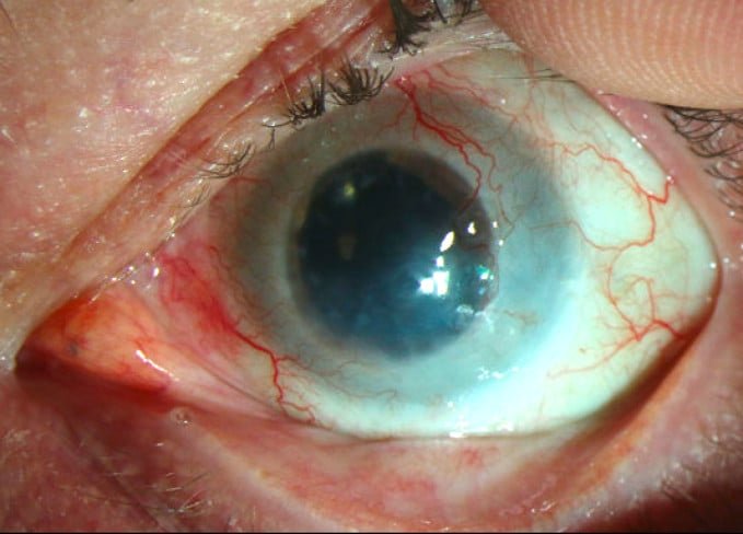 6-after-photo-of-cornea-post-calec 6. After Photo Of Cornea Post Calec