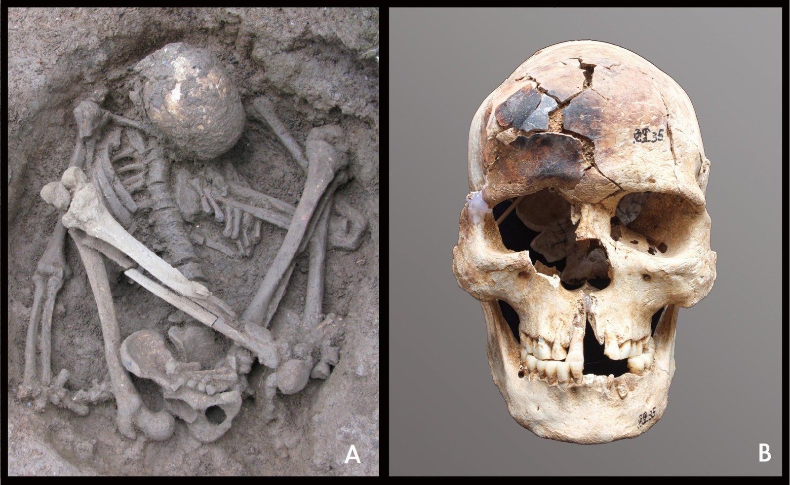 Hyperflexed Burial Position And Burnt Skull